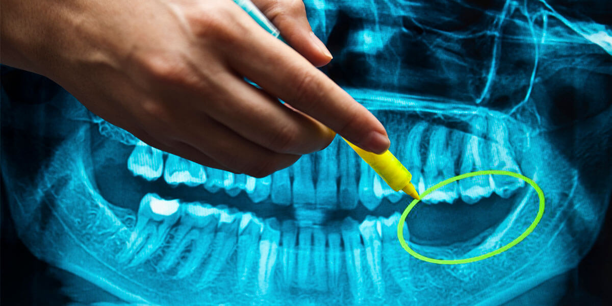 dental x-ray highlighting missing teeth and jaw bone resorption