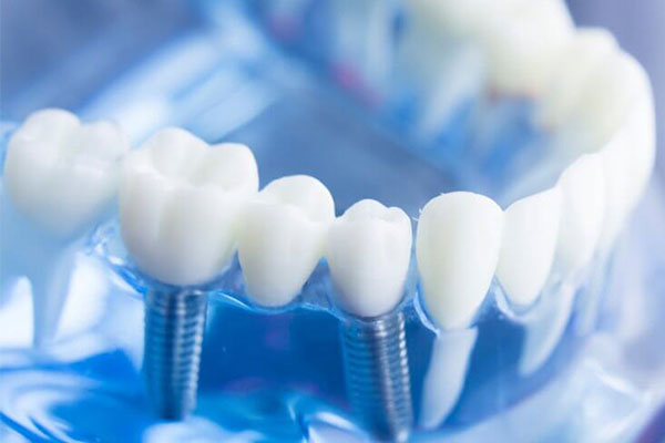 Dental Implants