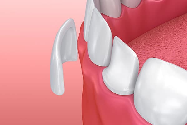 dental veneer illustration
