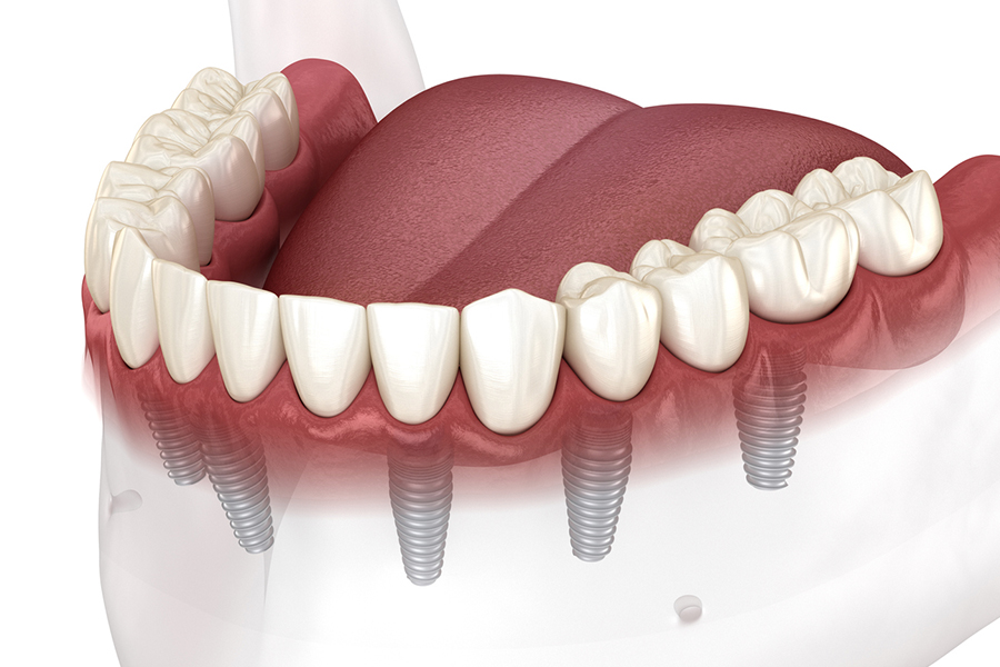 Full Arch with Only Four Implants clay model