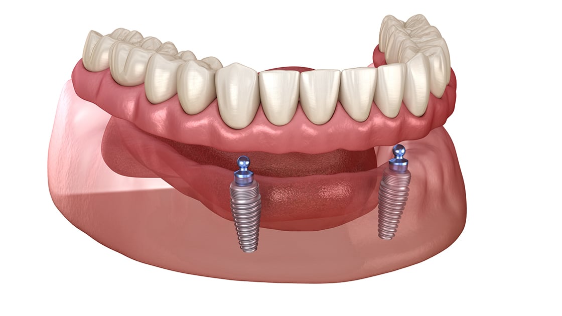 Implant Retained Denture Photo