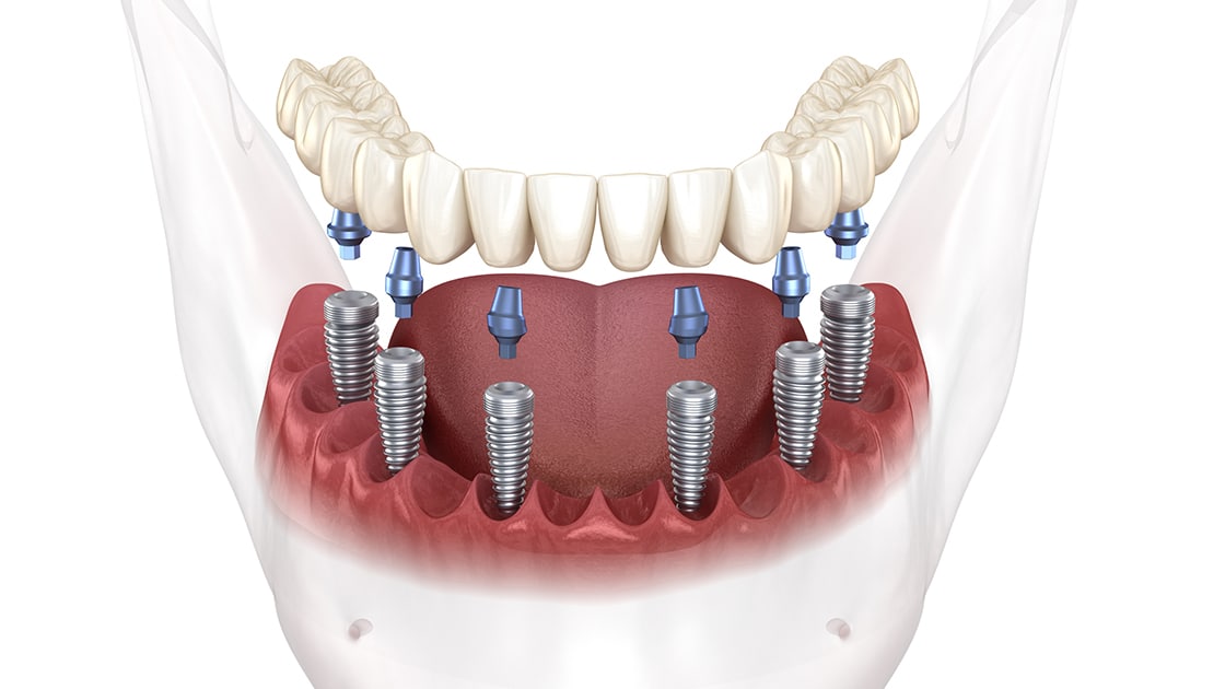 Implant Retained Dentures Photo