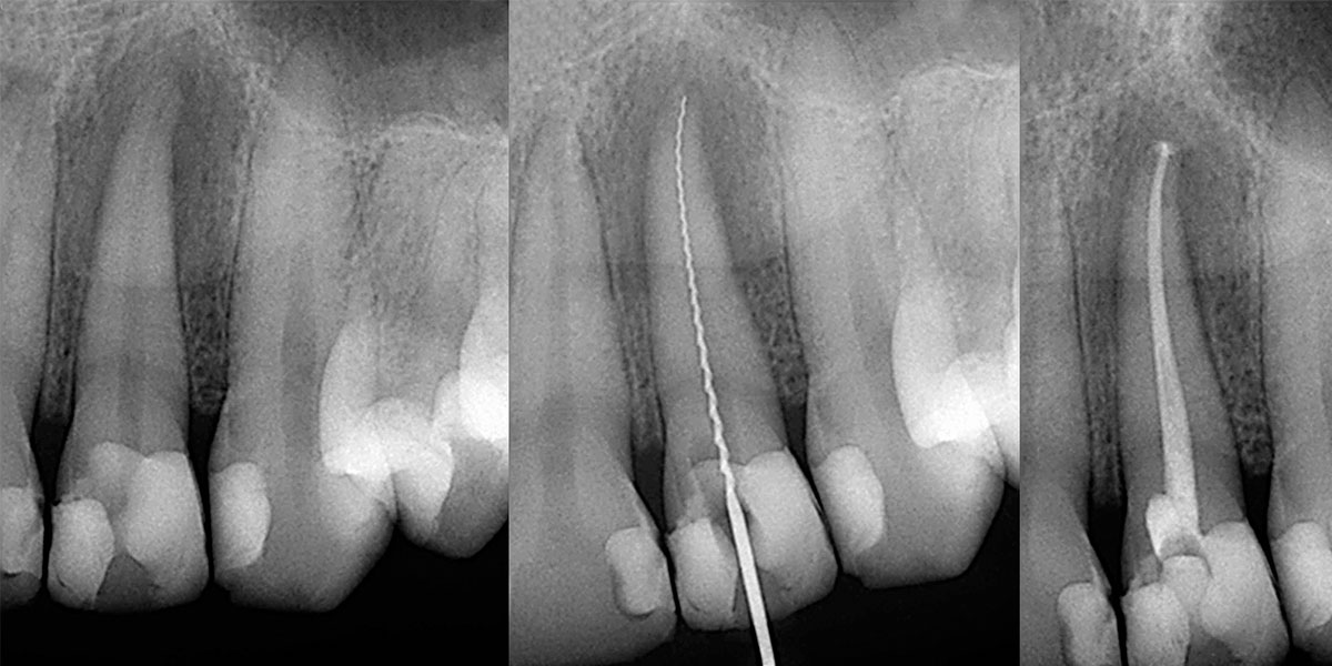 Root Canal Image